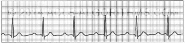 First Degree Heart Block