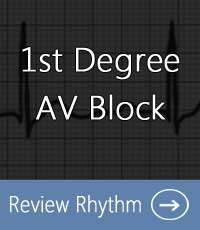 1st-Degree-AV-Block