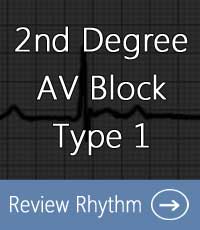 2nd-degree-av-block-type-1