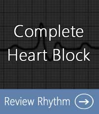 complete-heart-block