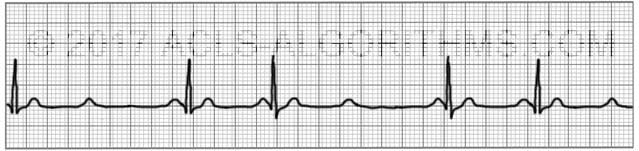 Second Degree AV Block Type 2 ACLS Algorithms