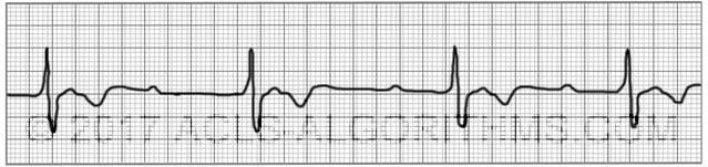 Third-Degree AV Block (Complete Block) | Learn & Master ACLS/PALS