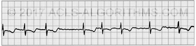 Atrial fibrillation ecg strip images 501