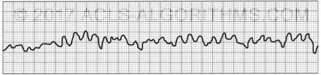 Ventricular fibrillation | ACLS-Algorithms.com