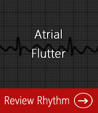 atrial-flutter