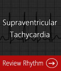 supraventricular-tachycardia