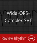 wide-QRS-complex-SVT
