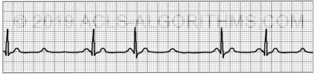 Second Degree AV Block Type 2 ACLS Algorithms