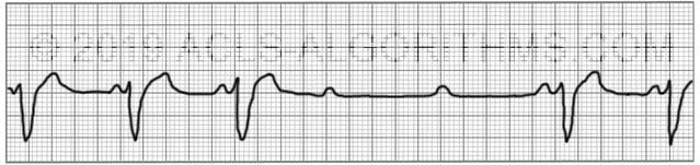 Second Degree AV Block Type 2 ACLS Algorithms