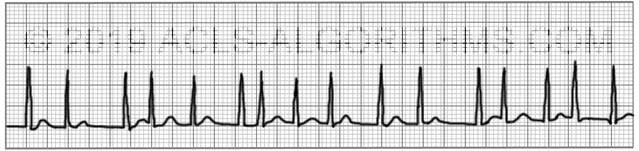 Atrial fibrillation | ACLS-Algorithms.com