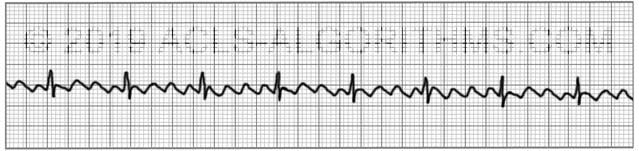 rapid flutter in chest
