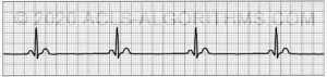 EKG Practice Test 1 - Learn & Master ACLS/PALS