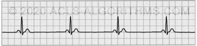 Cardiac rhythm strips test