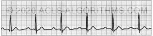 First degree heart block | ACLS-Algorithms.com