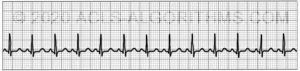 EKG Practice Test 1 - Learn & Master ACLS/PALS