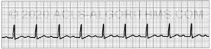 EKG Practice Test 1 - Learn & Master ACLS/PALS