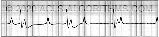 pals-ekg-practice-test-3-learn-master-acls-pals