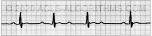 EKG Practice Test 1 - Learn & Master ACLS/PALS