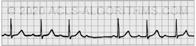 Second Degree AV Block ACLS Algorithms