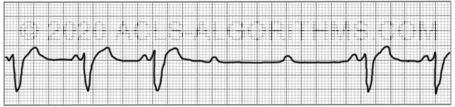 2nd Degree Heart Block Rhythm Strips Sale Online | www.jkuat.ac.ke