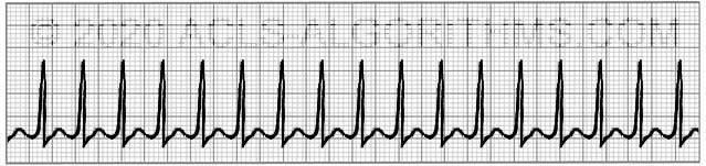 Supraventricular Tachycardia Svt Acls Algorithms Com