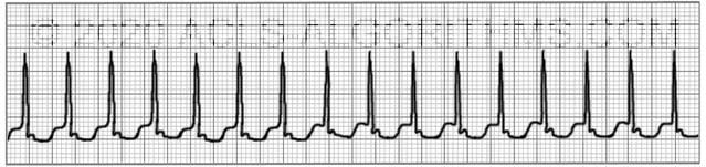 Supraventricular tachycardia (SVT) | ACLS-Algorithms.com