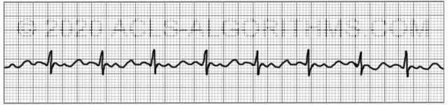 rapid flutter in chest