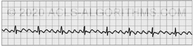 chest flutter