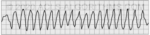 polymorphic ventricular tachycardia ecg