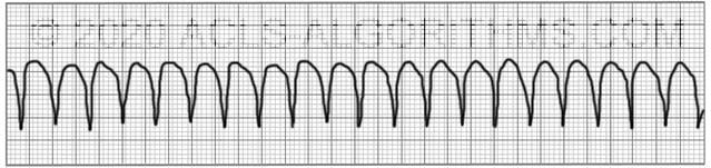 Pulseless Ventricular Tachycardia Acls Algorithms Com