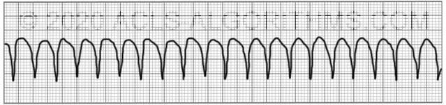 Coarse Ventricular Tachycardia