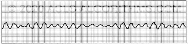 fine ventricular fibrillation vs coarse ventricular fibrillation