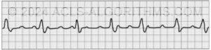 EKG Practice Test 1 - Learn & Master ACLS/PALS