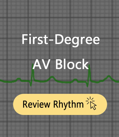 1st-Degree-AV-Block