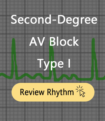 2nd-degree-av-block-type-1