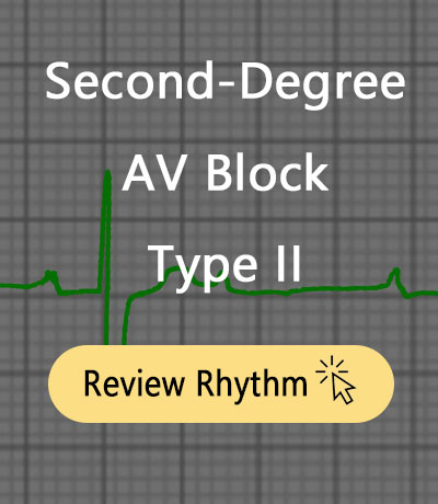 2nd-degree-av-block-type-2