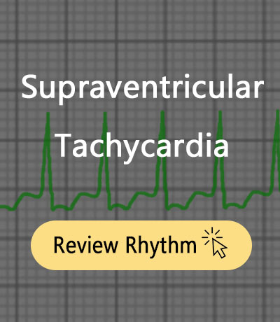 supraventricular-tachycardia
