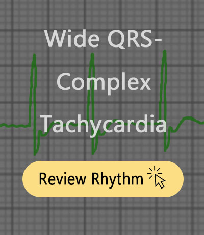wide-QRS-complex-SVT