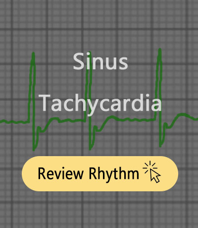 sinus-tachycardia