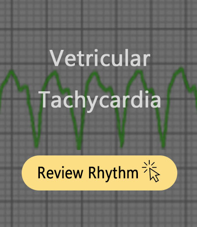 ventricular-tachycardia